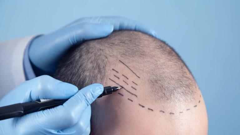 زراعة الشعر باقلام تشوي